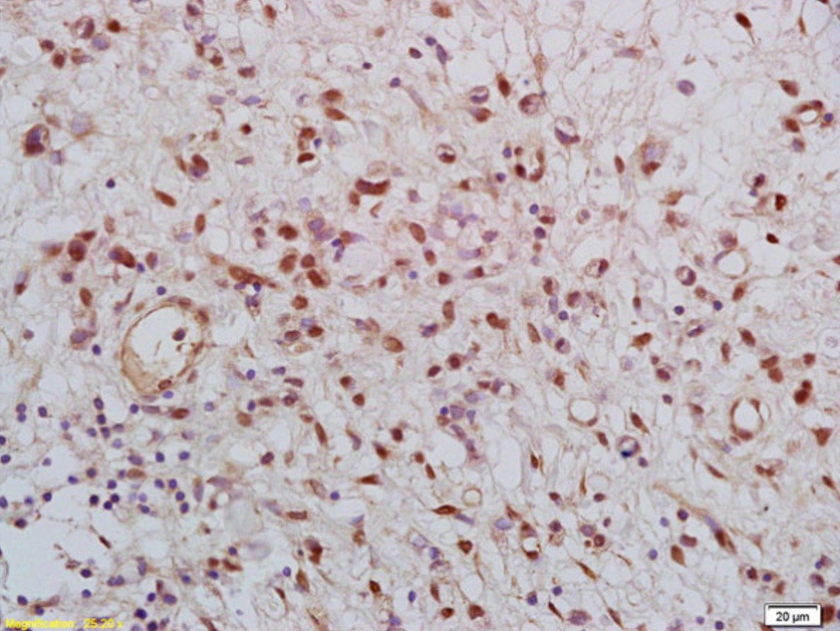Formalin-fixed and paraffin embedded human gastric carcinoma labeled with  Rabbit Anti KLK8 Polyclonal Antibody, Unconjugated (bs-5871R) at 1:200 followed by conjugation to the secondary antibody and DAB staining