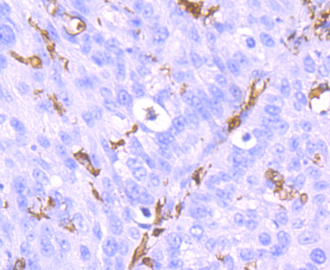 Paraformaldehyde-fixed and paraffin-embedded Human Lung Cancer tissue incubated with AIF1 (9A3) Monoclonal Antibody (bsm-54132R) at 1:100, overnight at 4°C, followed by a conjugated secondary antibody and DAB staining. Counterstained with hematoxylin.