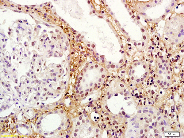 Formalin-fixed and paraffin embedded human kidney carcinoma labeled with Rabbit Anti RORG/ROR gamma Polyclonal Antibody, Unconjugated (bs-6217R) at 1:200 followed by conjugation to the secondary antibody and DAB staining