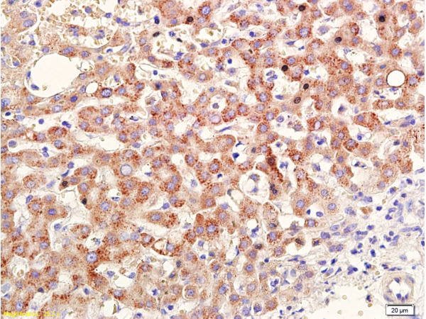 Formalin-fixed and paraffin embedded human cervical carcinoma labeled with Anti-RAR Beta Polyclonal Antibody (bs-0516), Unconjugated at 1:400, followed by conjugation to the secondary antibody and DAB staining