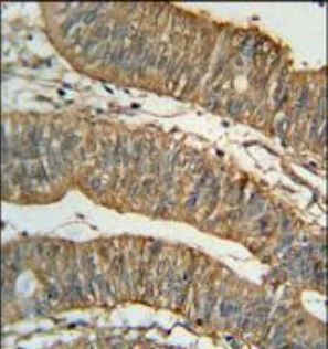 Paraformaldehyde-fixed and paraffin-embedded Human Colon Cancer tissue incubated with ALDH1A1 (2C2) Monoclonal Antibody (bsm-51032M) at 1:100, overnight at 4°C, followed by a conjugated secondary antibody and DAB staining. Counterstained with hematoxylin.