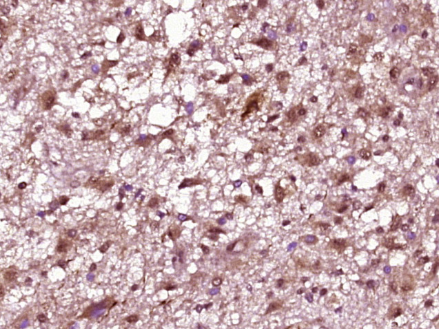 Paraformaldehyde-fixed, paraffin-embedded Human Brain Glioma; Antigen retrieval by boiling in sodium citrate buffer (pH6.0) for 15min; Block endogenous peroxidase by 3% hydrogen peroxide for 20 minutes; Blocking buffer (normal goat serum) at 37°C for 30min; Antibody incubation with NeuroD1 (Ser274) Polyclonal Antibody, Unconjugated (bs-19218R) at 1:400 overnight at 4°C, followed by secondary antibody, DAB and counterstaining.