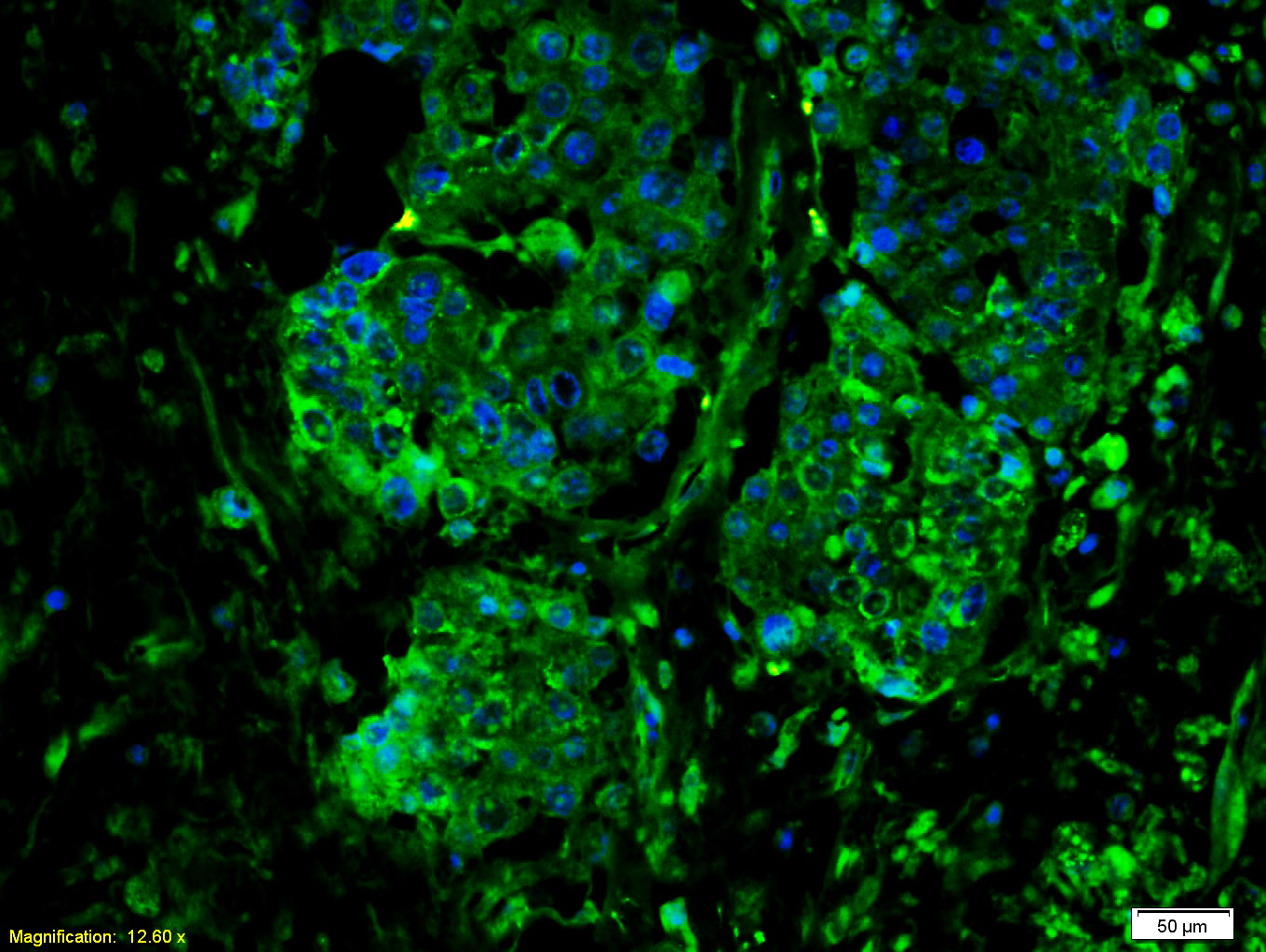 Paraformaldehyde-fixed, paraffin-embedded Human Colon Carcinoma; Antigen retrieval by boiling in sodium citrate buffer(0.01M, pH 6.0) for 15min; Blocking buffer (normal goat serum) at 37°C for 20min; Antibody incubation with IL-6R Beta/CD130/gp130 Antibody Polyclonal Antibody, Unconjugated (bs-1459R) at 1:300 overnight at 4°C. A Goat Anti-Rabbit IgG, FITC Conjugated secondary antibody (bs-0295G-FITC) was used for 40 mins at 37°C. DAPI (5ug/ml, blue) was used for nuclei staining.