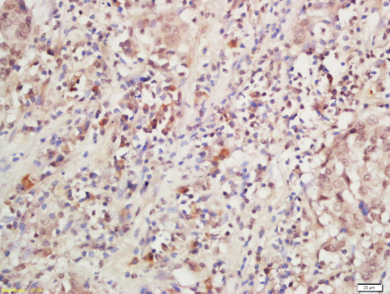 Tissue/cell: Human Laryngeal tissue; 4% Paraformaldehyde-fixed and paraffin-embedded; Antigen retrieval: citrate buffer (0.01M, pH 6.0), Boiling bathing for 15min; Block endogenous peroxidase by 3% Hydrogen peroxide for 30min; Blocking buffer (normal goat serum) at 37℃ for 20 min; Primary Incubation: IL-28R Polyclonal Antibody, Unconjugated (bs-11137R) at 1:200, overnight at 4°C. Followed by secondary antibody, DAB and counterstaining.