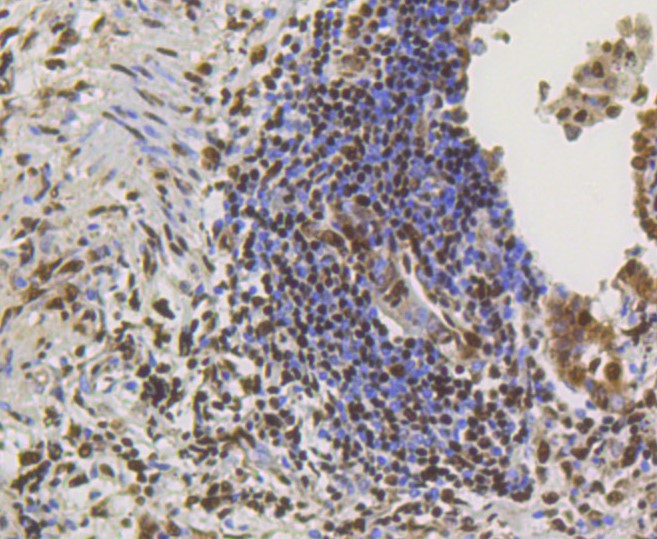 Paraformaldehyde-fixed and paraffin-embedded human lung cancer tissue incubated with CREB (2B5) Monoclonal Antibody (bsm-52245R) at 1:100, overnight at 4°C, followed by a conjugated secondary antibody and DAB staining. Counterstained with hematoxylin.