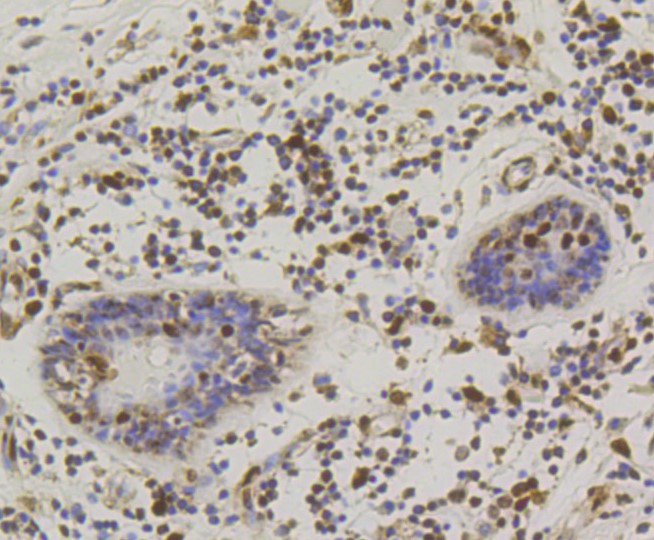 Paraformaldehyde-fixed and paraffin-embedded human breast carcinoma tissue incubated with CREB (2B5) Monoclonal Antibody (bsm-52245R) at 1:100, overnight at 4°C, followed by a conjugated secondary antibody and DAB staining. Counterstained with hematoxylin.