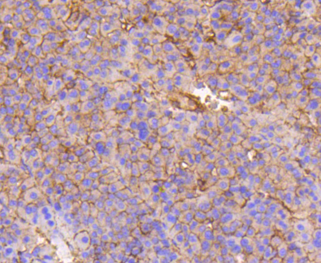 Paraformaldehyde-fixed and paraffin-embedded human liver cancer tissue incubated with Integrin beta 1 (1G11) Monoclonal Antibody (bsm-52247R) at 1:100, overnight at 4°C, followed by a conjugated secondary antibody and DAB staining. Counterstained with hematoxylin.