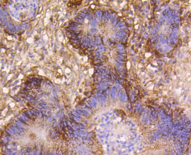 Paraformaldehyde-fixed and paraffin-embedded human colon cancer tissue incubated with Integrin beta 1 (1G11) Monoclonal Antibody (bsm-52247R) at 1:100, overnight at 4°C, followed by a conjugated secondary antibody and DAB staining. Counterstained with hematoxylin.