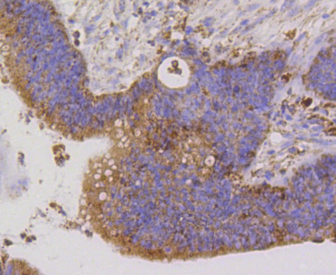 Paraformaldehyde-fixed and paraffin-embedded Human colon cancer tissue incubated with PBR (1D4) Monoclonal Antibody (bsm-52249R) at 1:100, overnight at 4°C, followed by a conjugated secondary antibody and DAB staining. Counterstained with hematoxylin.