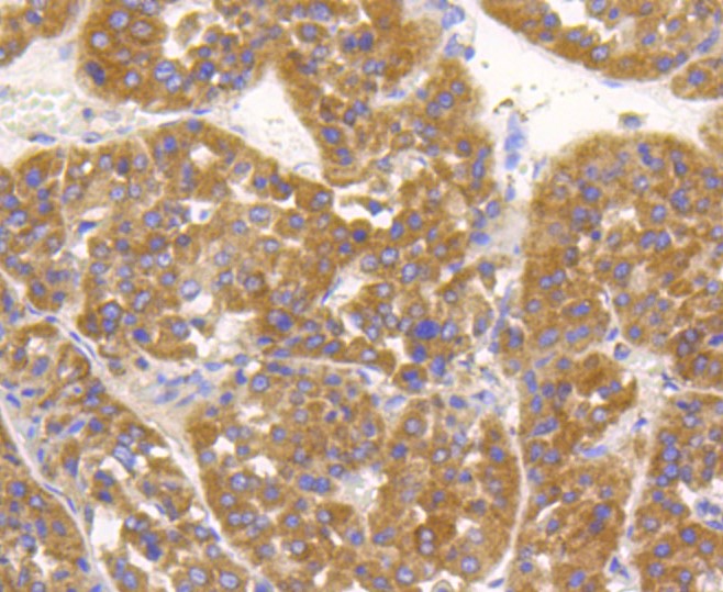Paraformaldehyde-fixed and paraffin-embedded Human liver cancer tissue incubated with Alkaline Phosphatase (1G9) Monoclonal Antibody (bsm-52252R) at 1:100, overnight at 4°C, followed by a conjugated secondary antibody and DAB staining. Counterstained with hematoxylin.