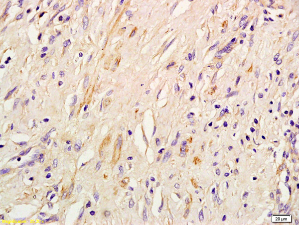 Formalin-fixed and paraffin embedded human lung inflammation labeled with  Rabbit Anti IRS-3 Polyclonal Antibody, Unconjugated (bs-0186R) at 1:200 followed by conjugation to the secondary antibody and DAB staining