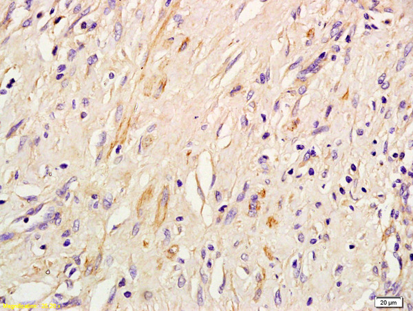 Formalin-fixed and paraffin embedded human lung inflammation labeled with Rabbit Anti IRS-3 Polyclonal Antibody, Unconjugated (bs-0186R) at 1:200 followed by conjugation to the secondary antibody and DAB staining