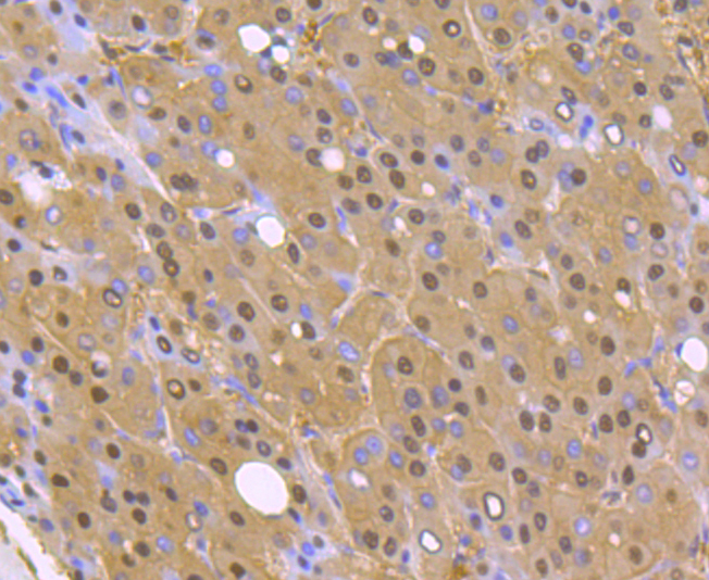 Paraformaldehyde-fixed and paraffin-embedded Human Liver Cancer tissue incubated with PSMA1 (10A2) Monoclonal Antibody (bsm-54170R) at 1:100, overnight at 4°C, followed by a conjugated secondary antibody and DAB staining. Counterstained with hematoxylin.