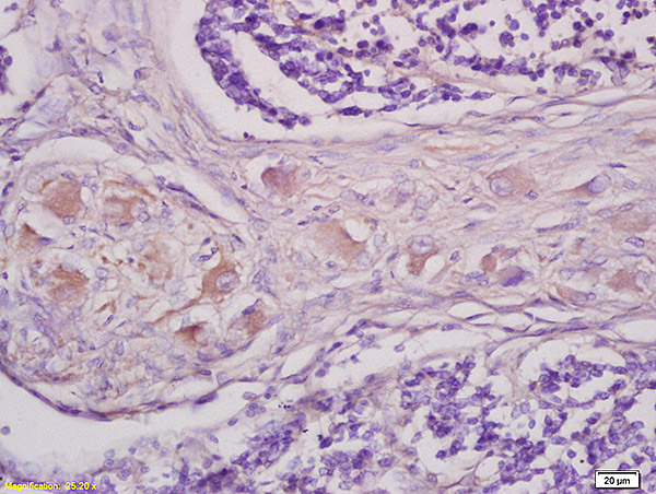Formalin-fixed and paraffin embedded human lung carcinoma tissue labeled with Anti GRM1 Polyclonal Antibody,Unconjugated (bs1803R) at 1:200 followed by conjugation to the secondary antibody and DAB staining.