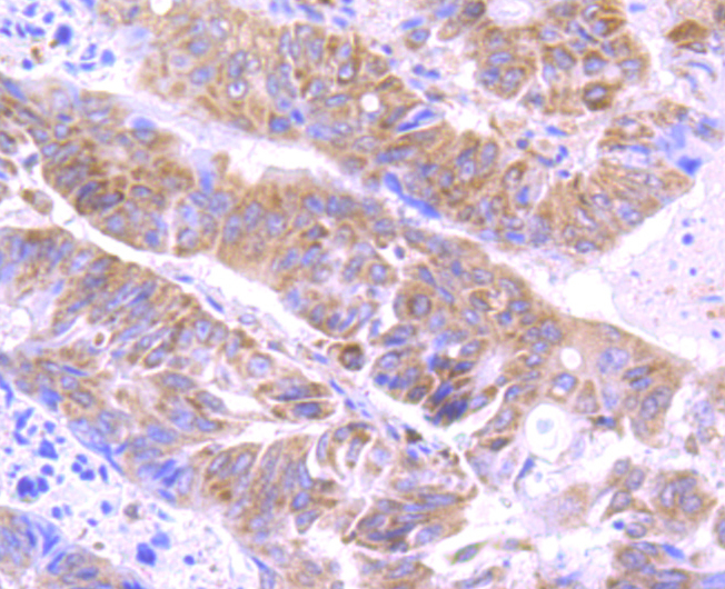 Paraformaldehyde-fixed and paraffin-embedded Human Colon Cancer tissue incubated with ATG3 (9C8) Monoclonal Antibody (bsm-54179R) at 1:100, overnight at 4°C, followed by a conjugated secondary antibody and DAB staining. Counterstained with hematoxylin.