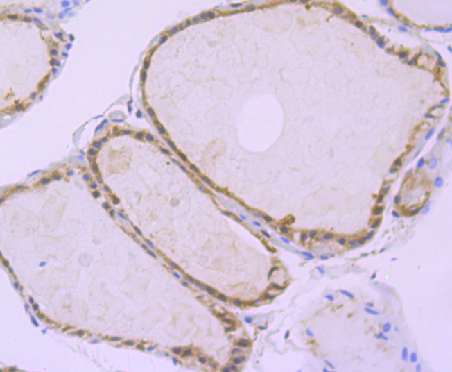 Paraformaldehyde-fixed and paraffin-embedded Human Thyroid tissue incubated with ATG3 (9C8) Monoclonal Antibody (bsm-54179R) at 1:100, overnight at 4°C, followed by a conjugated secondary antibody and DAB staining. Counterstained with hematoxylin.