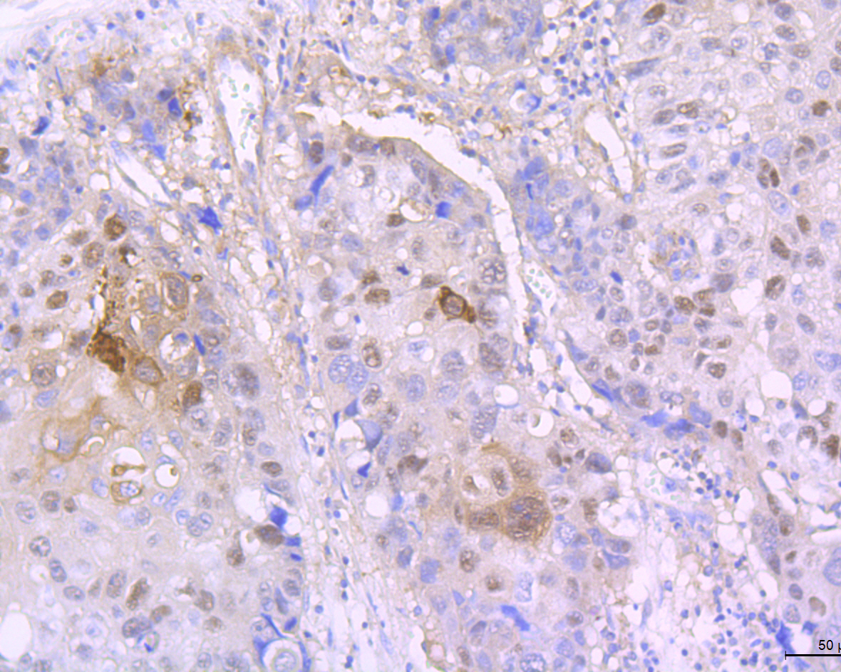 Paraformaldehyde-fixed and paraffin-embedded Human Lung Cancer tissue incubated with Involucrin (7C8) Monoclonal Antibody (bsm-54182R) at 1:100, overnight at 4°C, followed by a conjugated secondary antibody and DAB staining. Counterstained with hematoxylin.