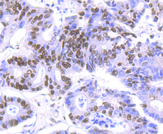 Paraformaldehyde-fixed and paraffin-embedded Human Colon Cancer tissue incubated with HDAC9 (2C9) Monoclonal Antibody (bsm-54186R) at 1:100, overnight at 4°C, followed by a conjugated secondary antibody and DAB staining. Counterstained with hematoxylin.