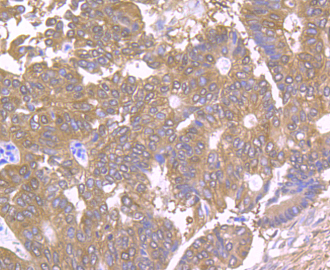 Paraformaldehyde-fixed and paraffin-embedded Human Colon Cancer tissue incubated with TPT1 (7C1) Monoclonal Antibody (bsm-54198R) at 1:100, overnight at 4°C, followed by a conjugated secondary antibody and DAB staining. Counterstained with hematoxylin.