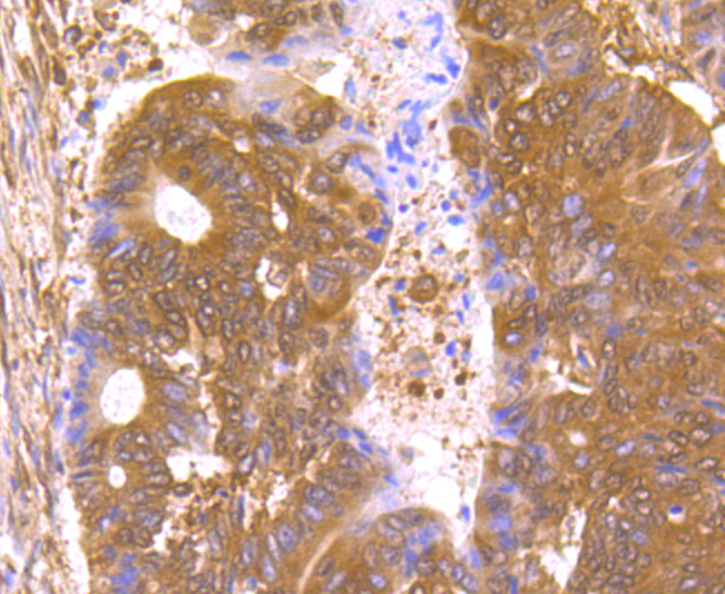 Paraformaldehyde-fixed and paraffin-embedded Human Colon Cancer tissue incubated with THOC1 (7G3) Monoclonal Antibody (bsm-54202R) at 1:100, overnight at 4°C, followed by a conjugated secondary antibody and DAB staining. Counterstained with hematoxylin.