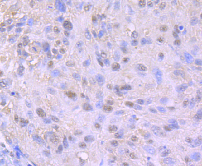Paraformaldehyde-fixed and paraffin-embedded Human Lung Cancer tissue incubated with THOC1 (7G3) Monoclonal Antibody (bsm-54202R) at 1:100, overnight at 4°C, followed by a conjugated secondary antibody and DAB staining. Counterstained with hematoxylin.