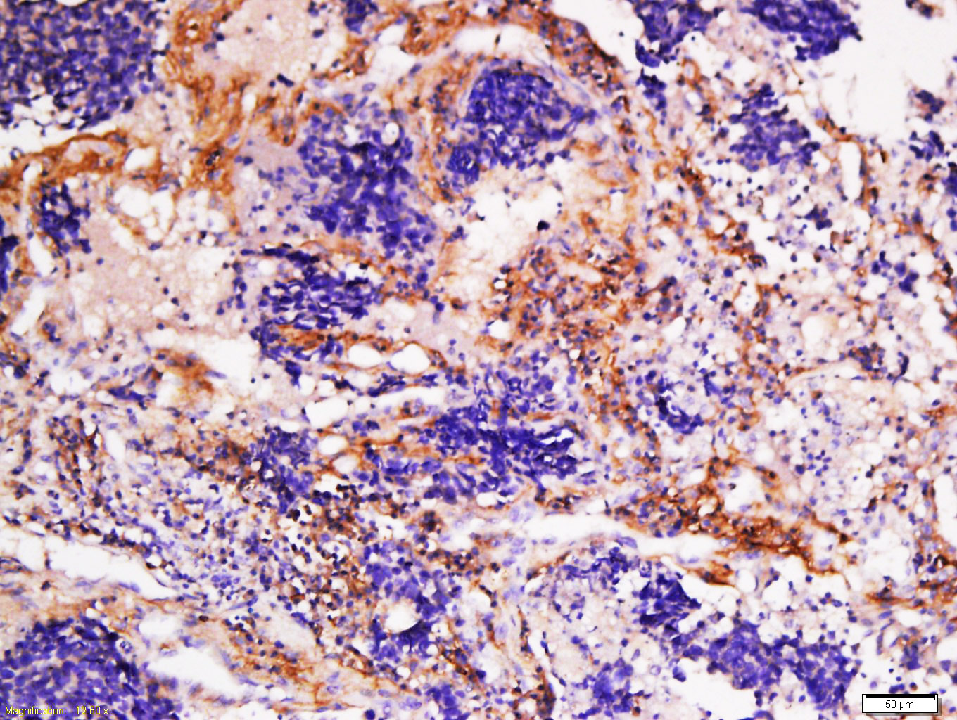 Paraformaldehyde-fixed, paraffin-embedded Human Lung Cancer tissue; Antigen retrieval by boiling in sodium citrate buffer (0.01M, pH6) for 15 minutes; Block endogenous peroxidase by 3% hydrogen peroxide for 30 minutes; Blocking buffer (normal goat serum) at 37°C for 20 minutes; Antibody incubation with Collagen 1 Polyclonal Antibody, Unconjugated (bs-10423R) at 1:200 overnight at 4°C, followed by a conjugated secondary antibody, DAB and counterstaining.