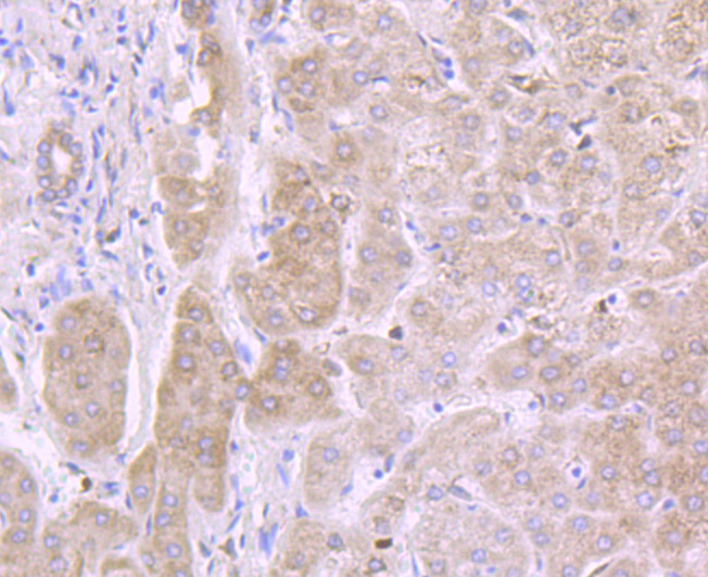 Paraformaldehyde-fixed and paraffin-embedded Human Liver tissue incubated with IL13 Receptor alpha 1 (1C1) Monoclonal Antibody (bsm-54211R) at 1:100, overnight at 4°C, followed by a conjugated secondary antibody and DAB staining. Counterstained with hematoxylin.