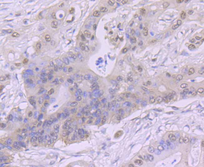 Paraformaldehyde-fixed and paraffin-embedded Human Colon Cancer tissue incubated with CSNK2B (2C9) Monoclonal Antibody (bsm-54217R) at 1:100, overnight at 4°C, followed by a conjugated secondary antibody and DAB staining. Counterstained with hematoxylin.