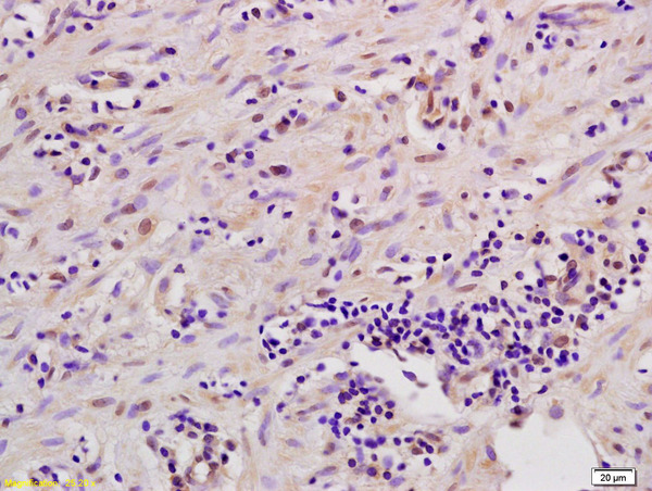 Formalin-fixed and paraffin embedded human gastric carcinoma labeled with Anti-MSK1/RPS6KA5 Polyclonal Antibody, Unconjugated (bs-2995R) at 1:200 followed by conjugation to the secondary antibody and DAB staining.