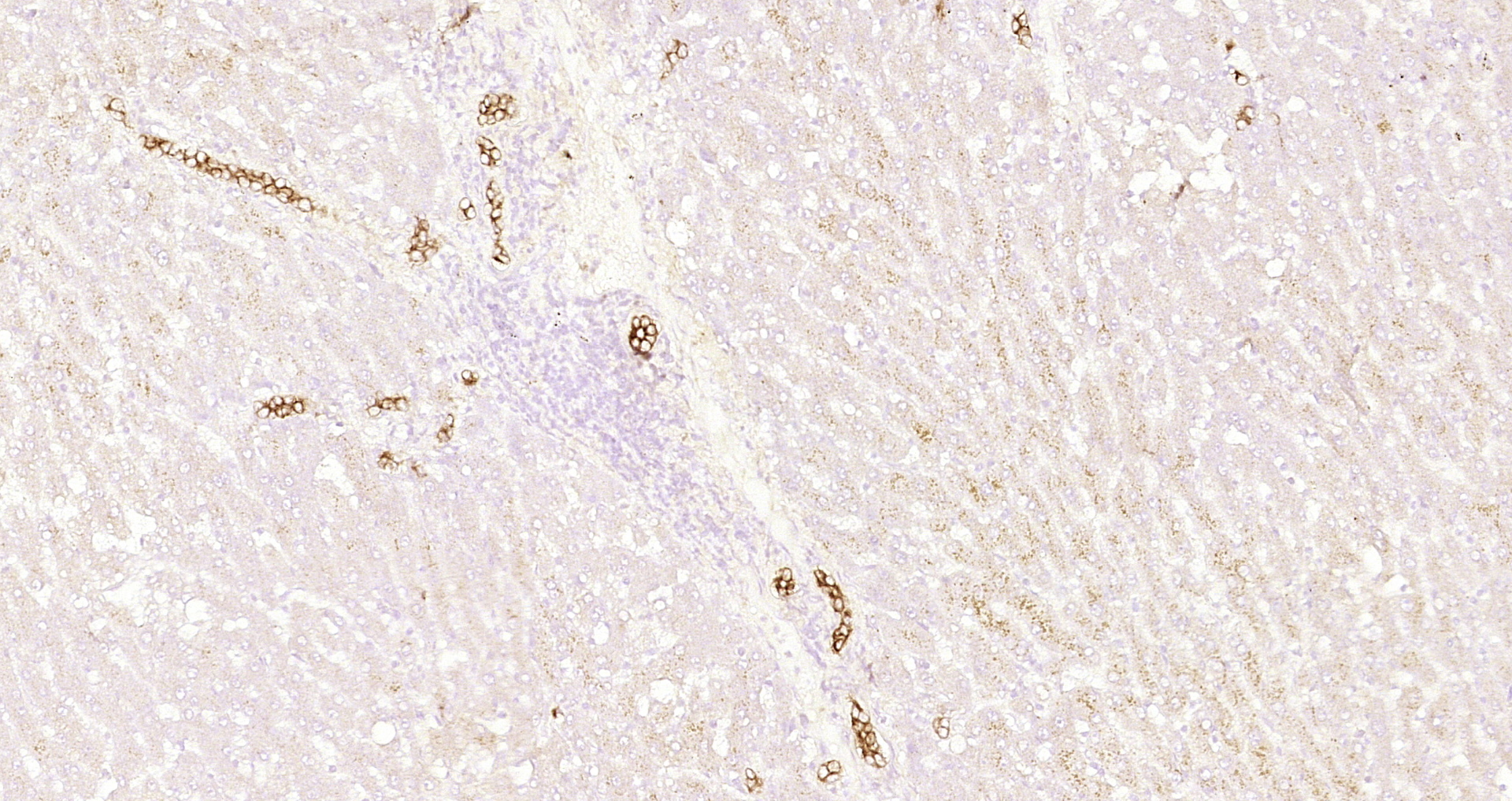 Paraformaldehyde-fixed, paraffin embedded Human liver cancer; Antigen retrieval by boiling in sodium citrate buffer (pH6.0) for 15min; Block endogenous peroxidase by 3% hydrogen peroxide for 20 minutes; Blocking buffer (normal goat serum) at 37°C for 30min; Antibody incubation with CK7 Monoclonal Antibody, Unconjugated (bsm-33060M) at 1:200 overnight at 4°C, DAB staining.