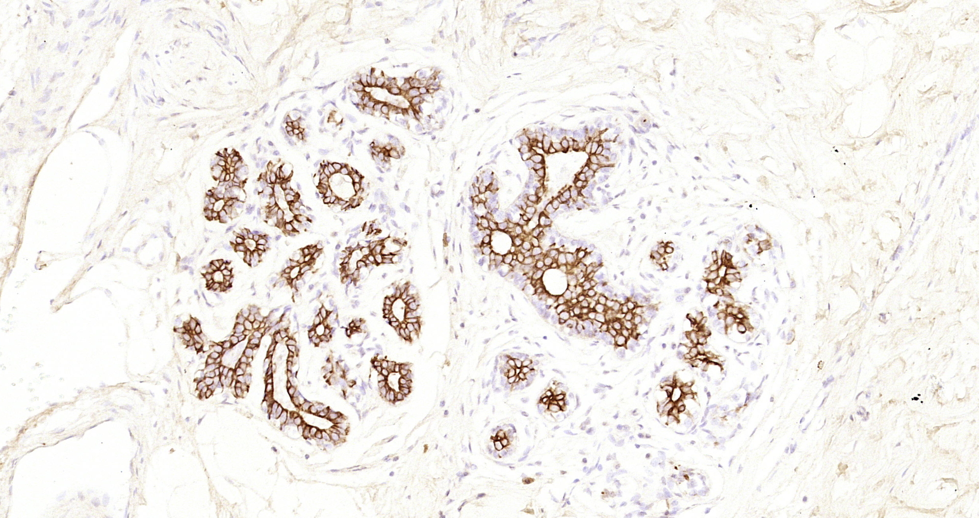 Paraformaldehyde-fixed, paraffin embedded Human breast; Antigen retrieval by boiling in sodium citrate buffer (pH6.0) for 15min; Block endogenous peroxidase by 3% hydrogen peroxide for 20 minutes; Blocking buffer (normal goat serum) at 37°C for 30min; Antibody incubation with CK7 Monoclonal Antibody, Unconjugated (bsm-33060M) at 1:200 overnight at 4°C, DAB staining.