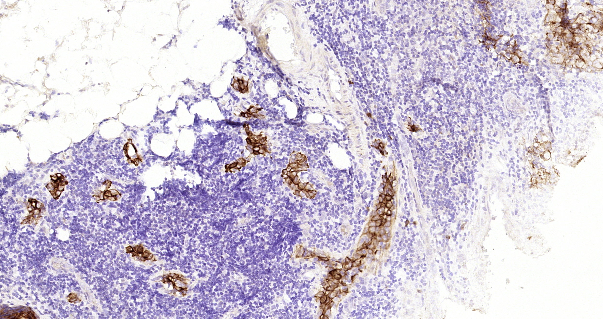 Paraformaldehyde-fixed, paraffin embedded Human esophagus; Antigen retrieval by boiling in sodium citrate buffer (pH6.0) for 15min; Block endogenous peroxidase by 3% hydrogen peroxide for 20 minutes; Blocking buffer (normal goat serum) at 37°C for 30min; Antibody incubation with CK7 Monoclonal Antibody, Unconjugated (bsm-33060M) at 1:200 overnight at 4°C, DAB staining.