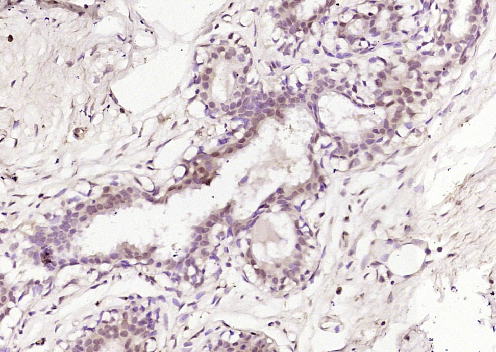 Paraformaldehyde-fixed, paraffin embedded Human Breast Cancer; Antigen retrieval by boiling in sodium citrate buffer (pH6.0) for 15min; Block endogenous peroxidase by 3% hydrogen peroxide for 20 minutes; Blocking buffer (normal goat serum) at 37°C for 30min; Antibody incubation with PADI4 Polyclonal Antibody, Unconjugated (bs-0318R) at 1:200 overnight at 4°C, DAB staining.