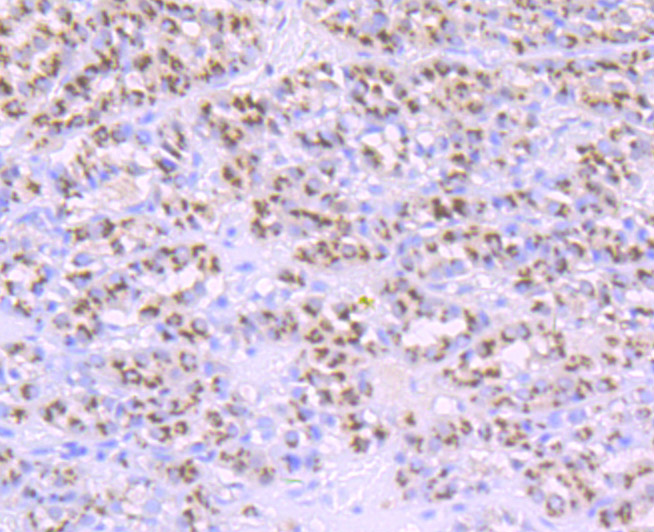 Paraformaldehyde-fixed and paraffin-embedded Human Liver Cancer tissue incubated with PSME1 (1C4) Monoclonal Antibody (bsm-54246R) at 1:100, overnight at 4°C, followed by a conjugated secondary antibody and DAB staining. Counterstained with hematoxylin.