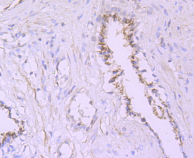 Paraformaldehyde-fixed and paraffin-embedded Human Prostate tissue incubated with PSME1 (1C4) Monoclonal Antibody (bsm-54246R) at 1:100, overnight at 4°C, followed by a conjugated secondary antibody and DAB staining. Counterstained with hematoxylin.