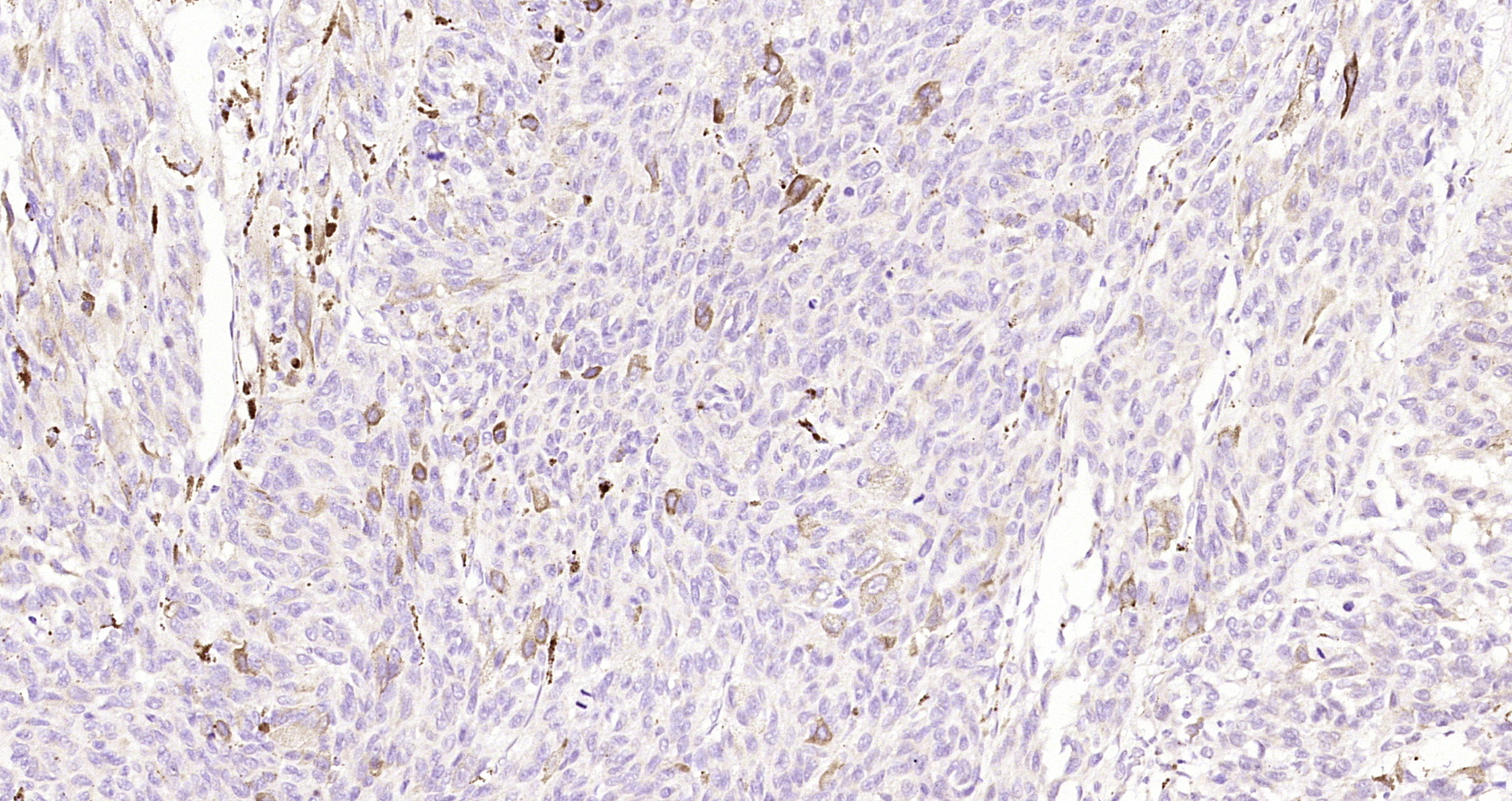 Paraformaldehyde-fixed, paraffin embedded Human melanoma; Antigen retrieval by boiling in sodium citrate buffer (pH6.0) for 15min; Block endogenous peroxidase by 3% hydrogen peroxide for 20 minutes; Blocking buffer (normal goat serum) at 37°C for 30min; Antibody incubation with MLANA/MART1 Polyclonal Antibody, Unconjugated (bs-0051R) at 1:200 overnight at 4°C, DAB staining.