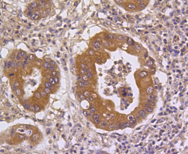 Paraformaldehyde-fixed and paraffin-embedded Human stomach cancer tissue incubated with DUSP6 (9C3) Monoclonal Antibody (bsm-52270R) at 1:100, overnight at 4°C, followed by a conjugated secondary antibody and DAB staining. Counterstained with hematoxylin.