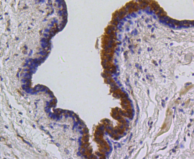 Paraformaldehyde-fixed and paraffin-embedded Human breast carcinoma tissue incubated with PUMA (2G6) Monoclonal Antibody (bsm-52276R) at 1:100, overnight at 4°C, followed by a conjugated secondary antibody and DAB staining. Counterstained with hematoxylin.