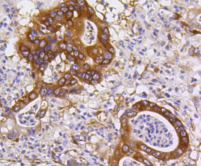 Paraformaldehyde-fixed and paraffin-embedded Human stomach carcinoma tissue incubated with PUMA (2G6) Monoclonal Antibody (bsm-52276R) at 1:100, overnight at 4°C, followed by a conjugated secondary antibody and DAB staining. Counterstained with hematoxylin.