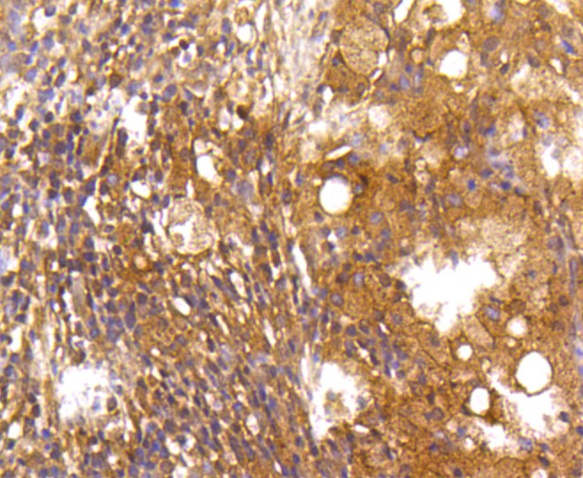 Paraformaldehyde-fixed and paraffin-embedded Human lung cancer tissue incubated with Caspase 2 (2B1) Monoclonal Antibody (bsm-52281R) at 1:100, overnight at 4°C, followed by a conjugated secondary antibody and DAB staining. Counterstained with hematoxylin.