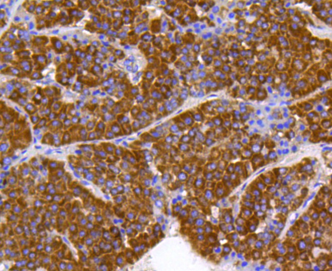 Paraformaldehyde-fixed and paraffin-embedded Human liver cancer tissue incubated with Prohibitin (1F10) Monoclonal Antibody (bsm-52282R) at 1:300, overnight at 4°C, followed by a conjugated secondary antibody and DAB staining. Counterstained with hematoxylin.
