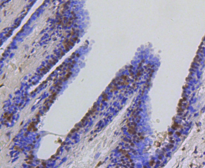 Paraformaldehyde-fixed and paraffin-embedded Human breast carcinoma tissue incubated with HSPA8 (4D2) Monoclonal Antibody (bsm-52284R) at 1:100, overnight at 4°C, followed by a conjugated secondary antibody and DAB staining. Counterstained with hematoxylin.