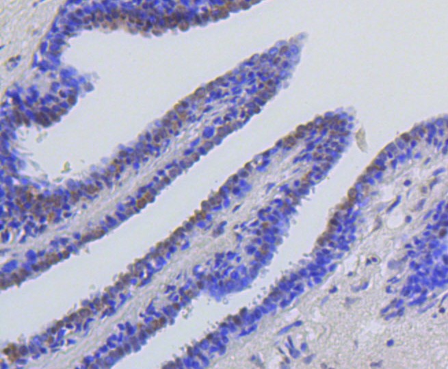 Paraformaldehyde-fixed and paraffin-embedded Human breast carcinoma tissue incubated with Histone H2A (acetyl K9) (4G2) Monoclonal Antibody (bsm-52285R) at 1:100, overnight at 4°C, followed by a conjugated secondary antibody and DAB staining. Counterstained with hematoxylin.