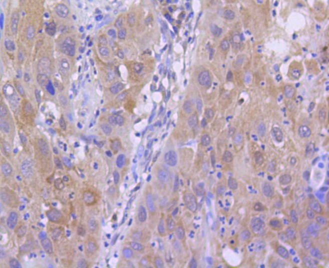 Paraformaldehyde-fixed and paraffin-embedded Human lung carcinoma tissue incubated with Histone H2A (acetyl K9) (4G2) Monoclonal Antibody (bsm-52285R) at 1:100, overnight at 4°C, followed by a conjugated secondary antibody and DAB staining. Counterstained with hematoxylin.