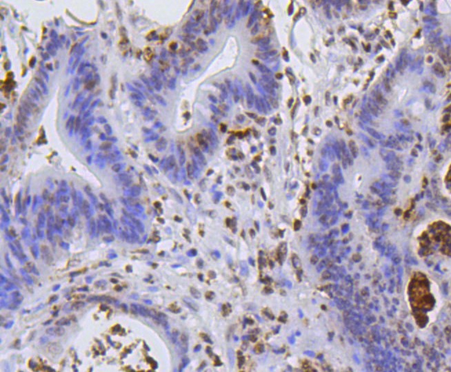 Paraformaldehyde-fixed and paraffin-embedded Human colon cancer tissue incubated with Histone H2A (hydroxyl Y39) (2A3) Monoclonal Antibody (bsm-52286R) at 1:100, overnight at 4°C, followed by a conjugated secondary antibody and DAB staining. Counterstained with hematoxylin.