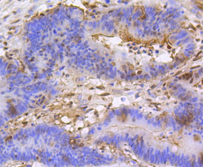 Paraformaldehyde-fixed and paraffin-embedded Human colon cancer tissue incubated with Histone H3 (mono+di+methyl K79) (2B11) Monoclonal Antibody (bsm-52291R) at 1:100, overnight at 4°C, followed by a conjugated secondary antibody and DAB staining. Counterstained with hematoxylin.