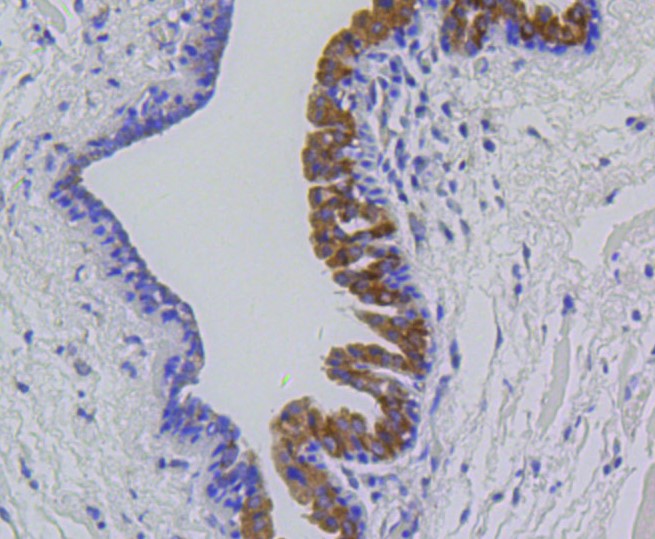 Paraformaldehyde-fixed and paraffin-embedded Human breast carcinoma tissue incubated with MMP12 (1A4) Monoclonal Antibody (bsm-52292R) at 1:100, overnight at 4°C, followed by a conjugated secondary antibody and DAB staining. Counterstained with hematoxylin.