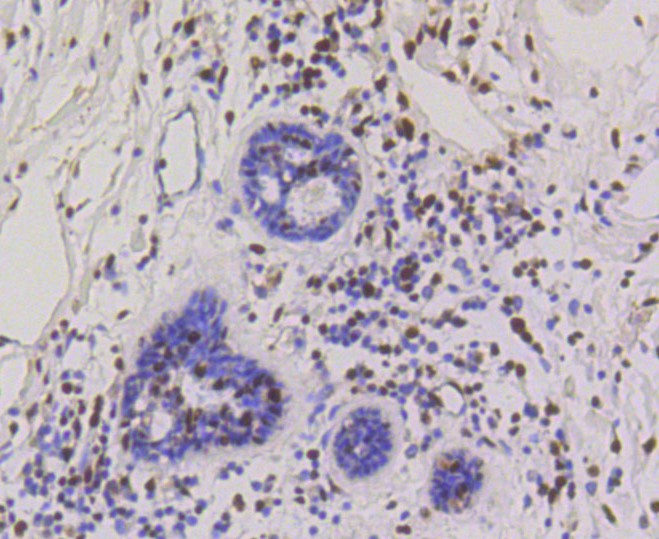 Paraformaldehyde-fixed and paraffin-embedded Human breast carcinoma tissue incubated with CBX5 (3G1) Monoclonal Antibody (bsm-52301R) at 1:100, overnight at 4°C, followed by a conjugated secondary antibody and DAB staining. Counterstained with hematoxylin.