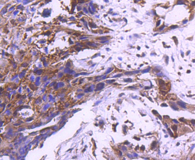 Paraformaldehyde-fixed and paraffin-embedded Human breast carcinoma tissue incubated with MAP2K1 (7D8) Monoclonal Antibody (bsm-52311R) at 1:100, overnight at 4°C, followed by a conjugated secondary antibody and DAB staining. Counterstained with hematoxylin.