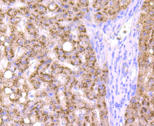 Paraformaldehyde-fixed and paraffin-embedded Human liver cancer tissue incubated with Cathepsin B (3C9) Monoclonal Antibody (bsm-52977R) at 1:100, overnight at 4°C, followed by a conjugated secondary antibody and DAB staining. Counterstained with hematoxylin.